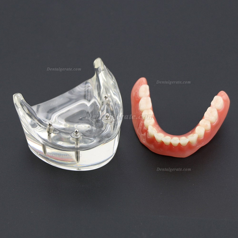 Dental Lower Z&auml;hne Demo-Studienmodell 6002 02 Overdenture Unten 4 Implantate